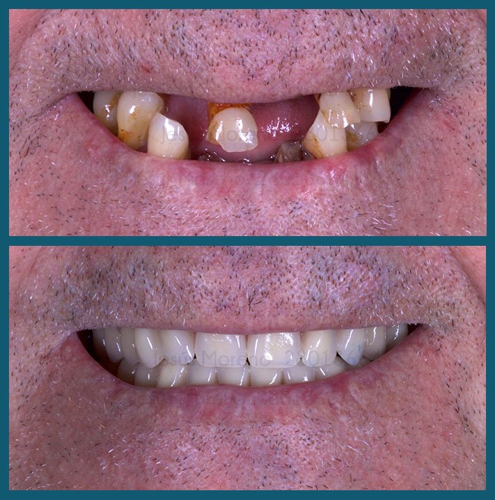 implantes dentales en móstoles