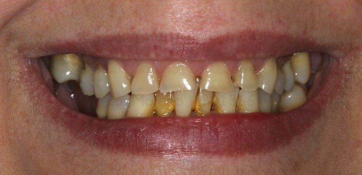 foto antes del tratamiento de implantes y carillas