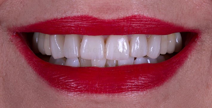 Foto fnal después tratamiento con implantes y carillas