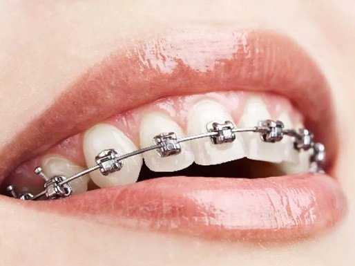 ¿Qué tipo de brackets existen?