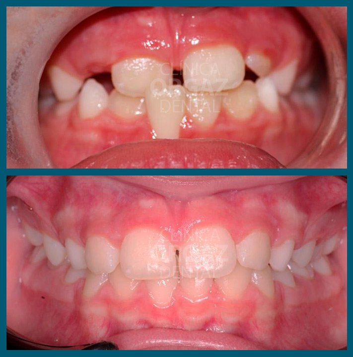 Tratamiento de Ortodoncia con técnica Neuro Oclusal