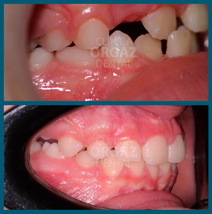 vista lateral Tratamiento de Ortodoncia- con técnica Neuro Oclusal