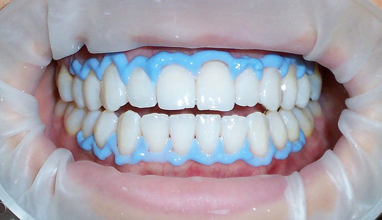 Blanqueamiento dental es seguro cuándo recomendable