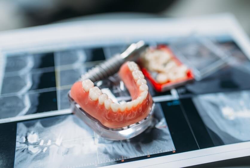 Tratamiento Dental con Prótesis: Soluciones a Medida
