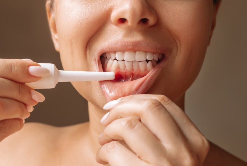 Periodoncia Avanzada: Cómo Combatir la Enfermedad de las Encías
