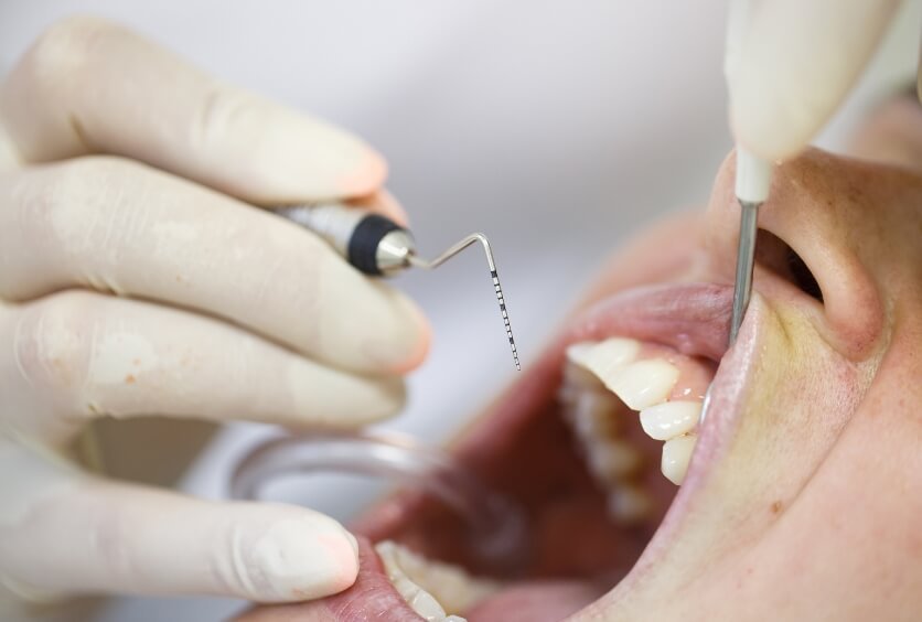 Periodoncia Avanzada: Cómo Combatir la Enfermedad de las Encías