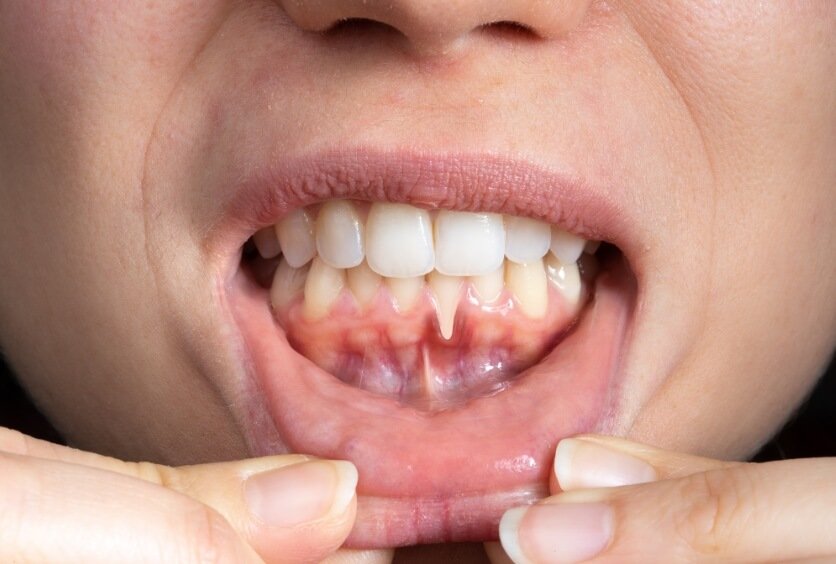 Periodoncia Avanzada: Cómo Combatir la Enfermedad de las Encías