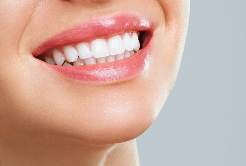 Blanqueamiento Dental Profesional