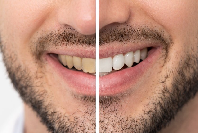 Manchas en los Dientes: Causas, Diagnóstico y cómo Eliminarlas de Forma Segura