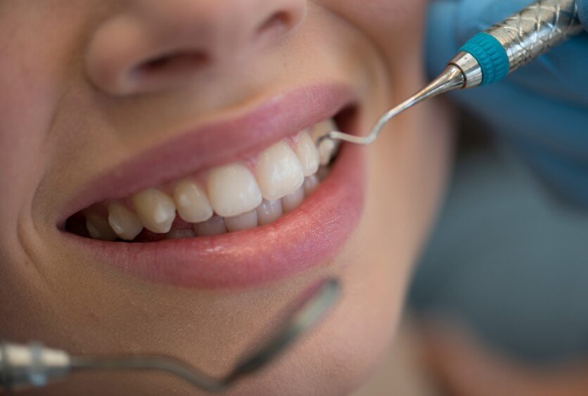 Manchas en los Dientes: Causas, Diagnóstico y cómo Eliminarlas de Forma Segura