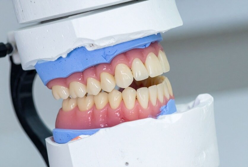 Prótesis dentales: tipos, diferencias, indicaciones y cómo elegir la solución adecuada