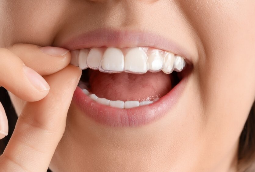 Ortodoncia Invisible y Prótesis Dentales: Cuándo Combinarlas y cómo Planificarlas