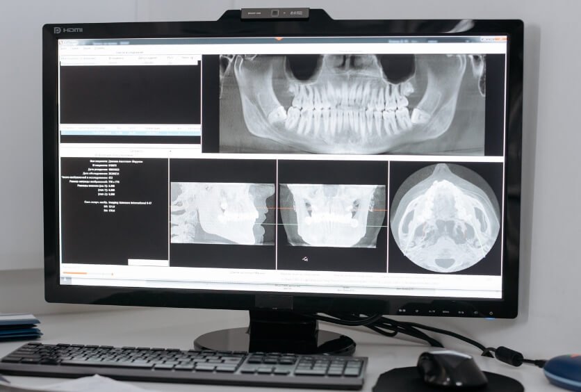 TAC dental: Diagnóstico en 3D para Implantes, Cirugía y Tratamientos más Precisos
