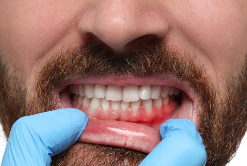 Periodoncia: Qué es, Cómo se Trata y Por qué es Clave para Conservar tus Dientes