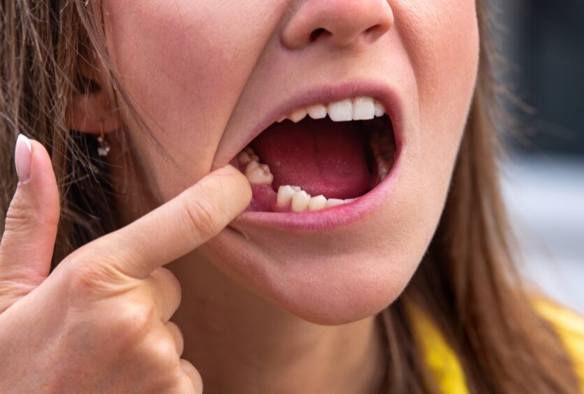 Cómo Evitar La Pérdida De Piezas Dentales: Prevención, Hábitos Y Tratamientos Clave Para Conservar Tu Sonrisa