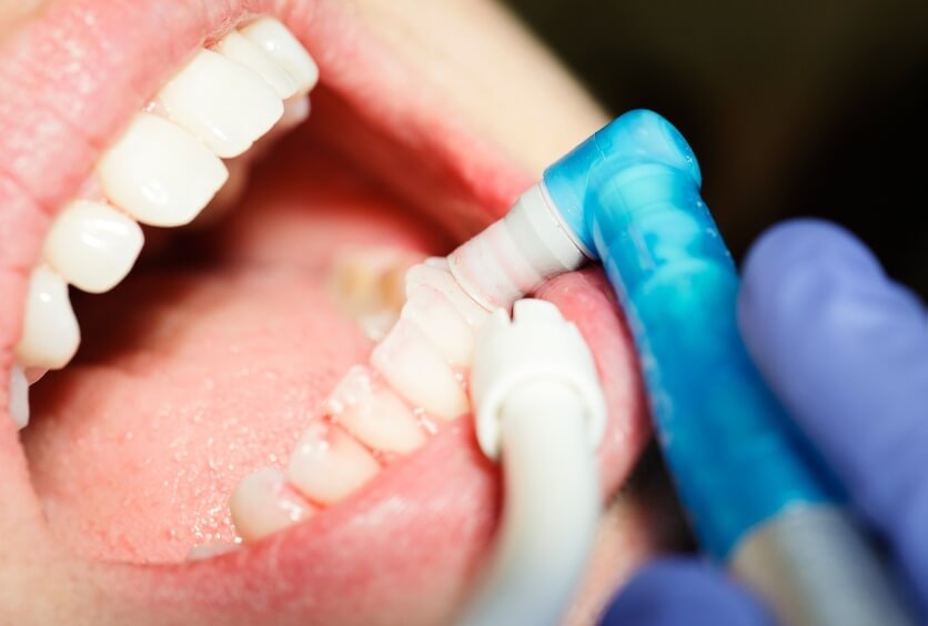 Mitos Y Realidades Del Flúor En La Prevención De Caries