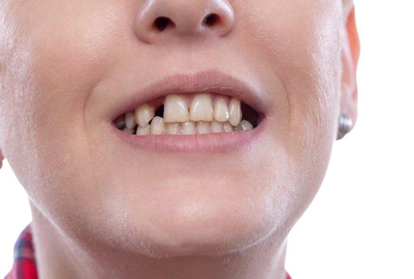 Cómo Evitar La Pérdida De Piezas Dentales: Prevención, Hábitos Y Tratamientos Clave Para Conservar Tu Sonrisa
