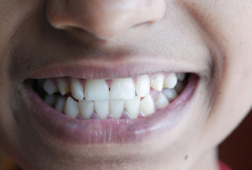 Encías Retraídas: Por Qué Aparecen, Cómo Frenarlas y Qué Tratamientos Existen