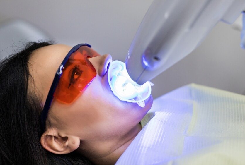 Blanqueamiento Dental En Verano: Cuidados, Recomendaciones Y Lo Que Debes Saber