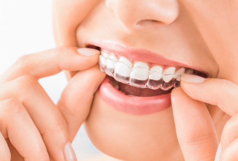 Ortodoncia En Verano: Cuidados, Ventajas Y Recomendaciones Para Mantener Tu Tratamiento