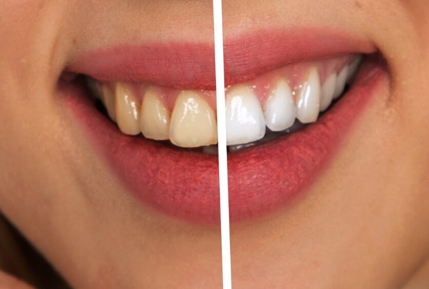 Blanqueamiento Dental En Verano: Cuidados, Recomendaciones Y Lo Que Debes Saber