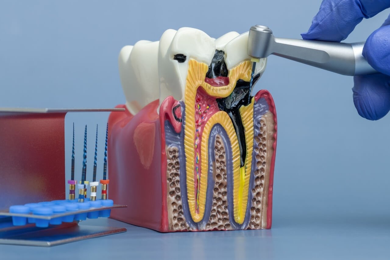 Endodoncia: Cómo Salvar un Diente, Evitar su Extracción y Tratarlo con las Técnicas Actuales