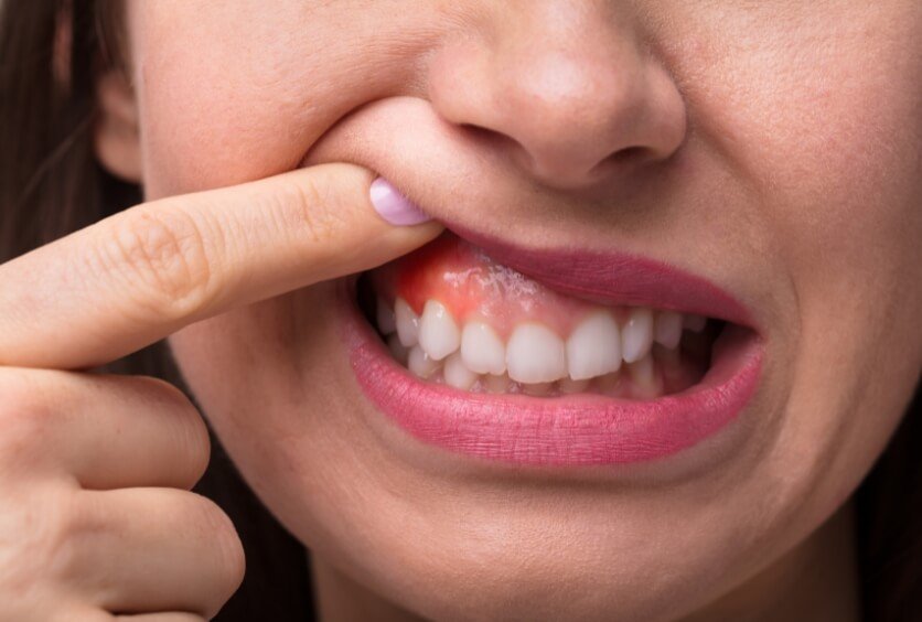 Encías Inflamadas O Que Sangran: Señales De Que Algo No Va Bien